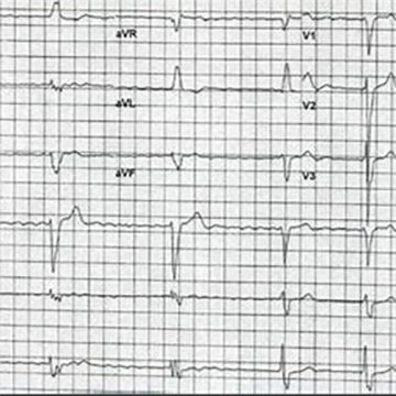 ecg app移动心电图房颤提示软件