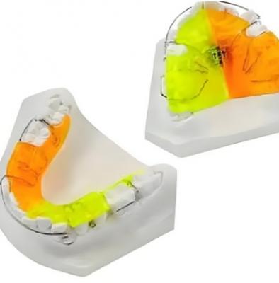 登特菲定制式正畸矫治器零售价