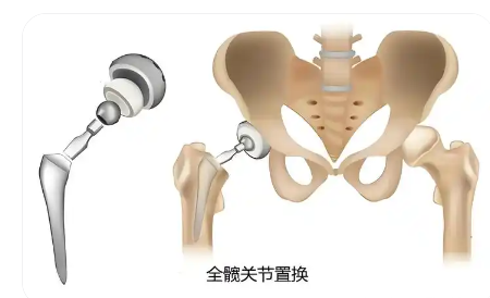 髋关节置换手术导航定位系统ropaplasty-01代理